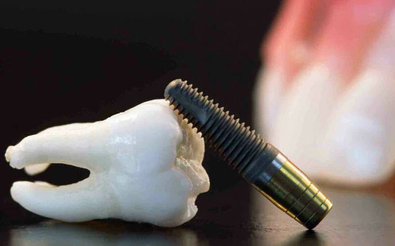 implantes dentales barcelona
